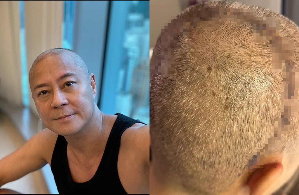 草蜢蔡一傑證實「癌細胞擴散」！1個月後近況曝光 惹歌迷心疼