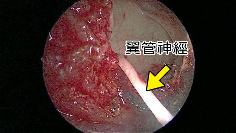 一換季就狂打噴嚏、流鼻水！他過敏性鼻炎開刀仍復發　醫1招除心頭大患