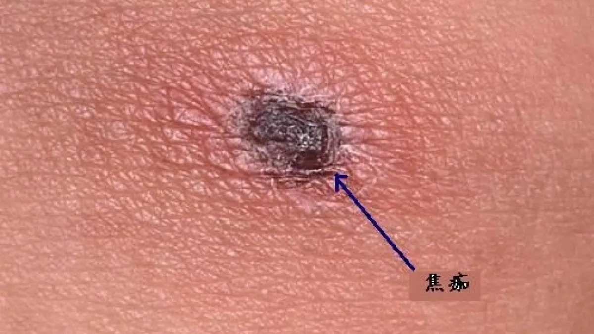 暑假出遊注意！恙蟲病創4年新高　身體...
