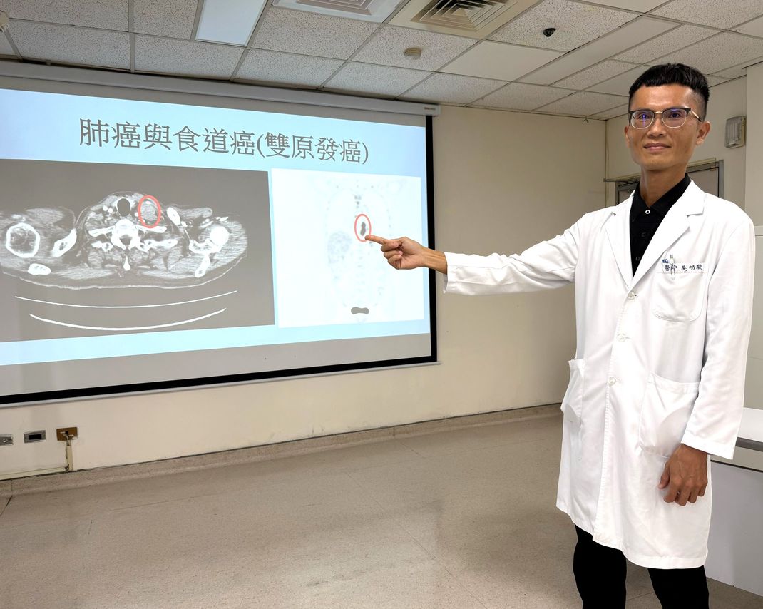 企業主罹肺腺癌與食道癌 醫師建議定期...