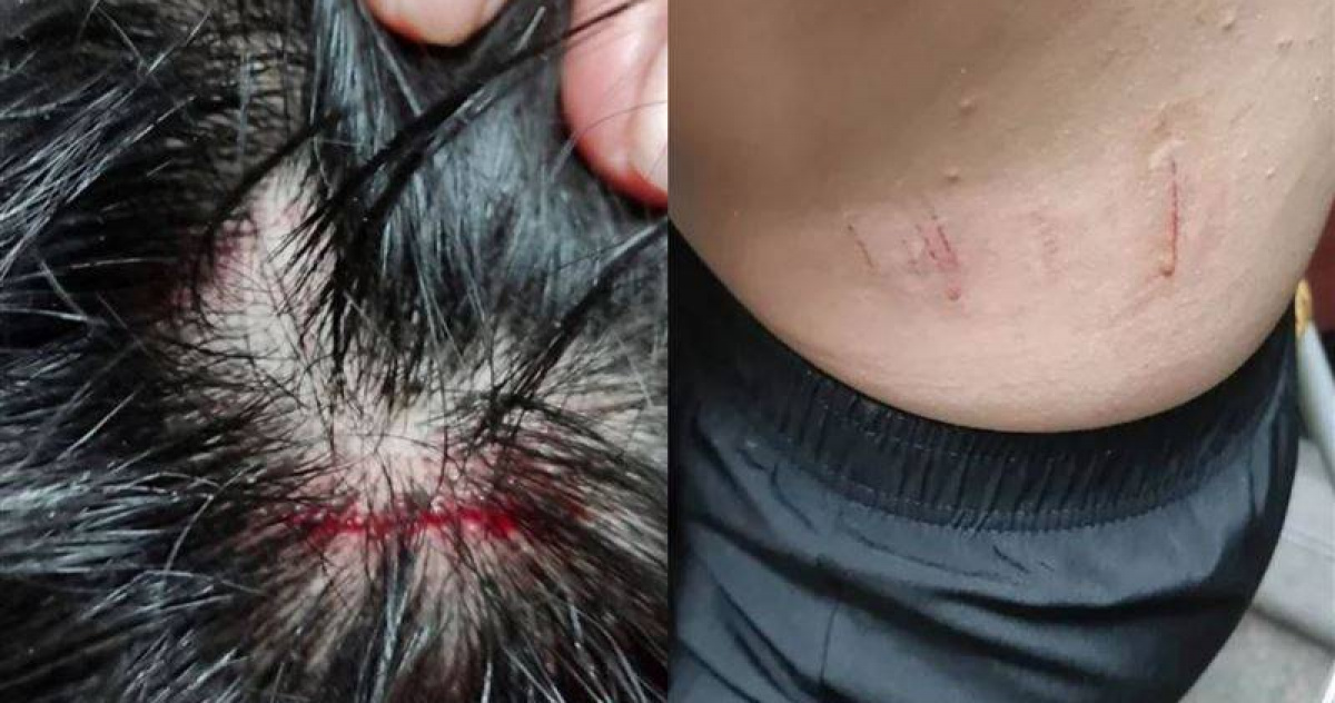 遭10多隻流浪犬緊追！彰化男童摔車撞...